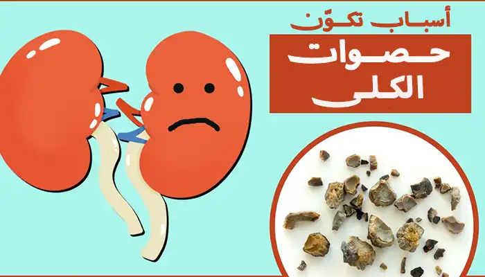 أسباب تكوّن حصوات الكلى