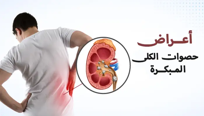 أعراض حصوات الكلى المبكرة