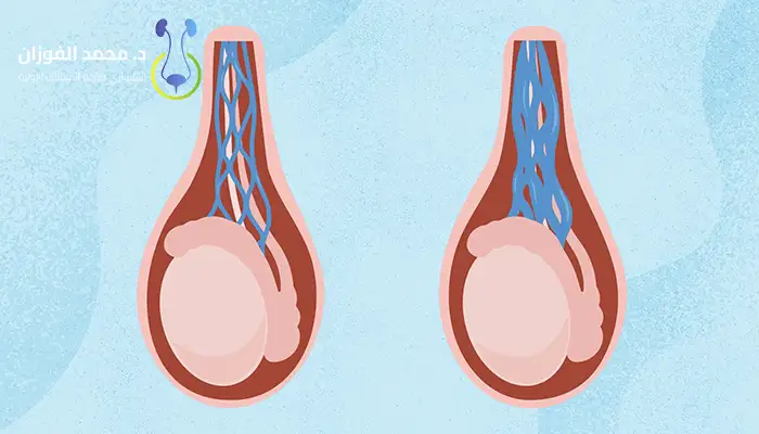 أعراض دوالي الخصية عند الشباب