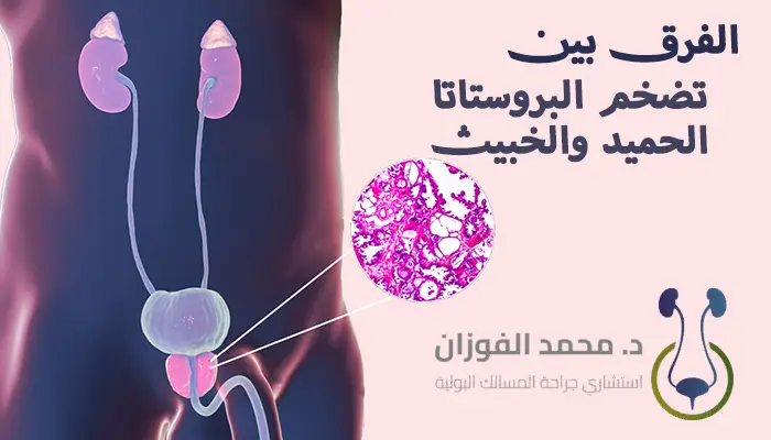 الفرق بين تضخم البروستاتا الحميد والخبيث