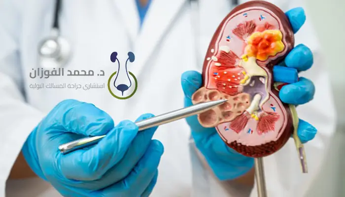 علاج أورام الكلى في السعودية