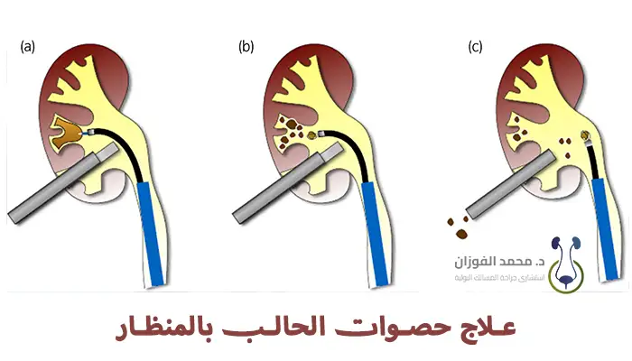 علاج حصوات الحالب بالمنظار