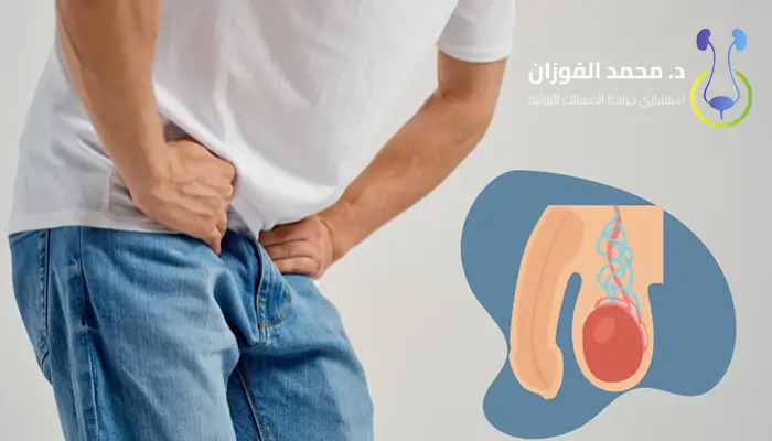 علاج دوالي الخصية بدون جراحة