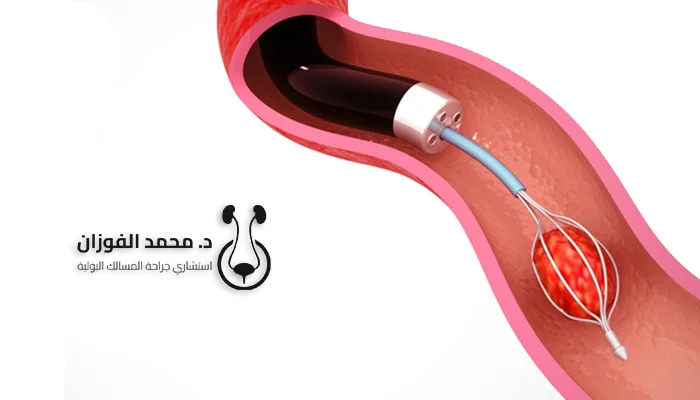 كم تستغرق عملية إزالة حصوة الكلى؟