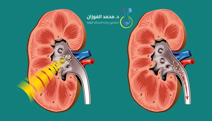 أفضل مركز لعلاج حصوات الكلى بالليزر بالرياض