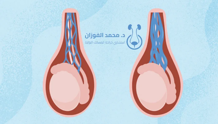 تأثير دوالي الخصية على الخصوبة