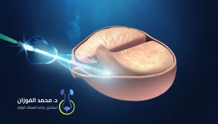 تكلفة علاج تضخم البروستاتا بالليزر