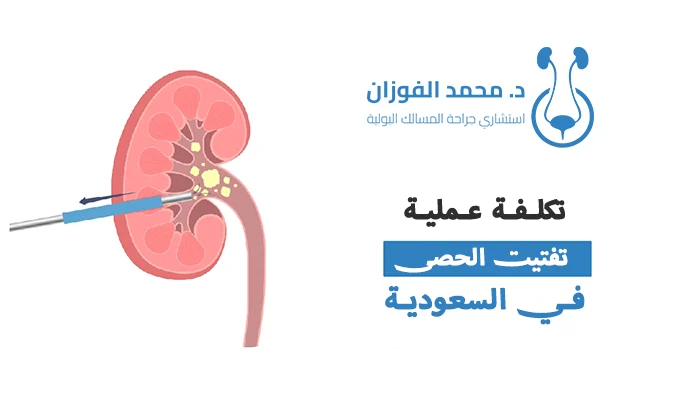 تكلفة عملية تفتيت الحصى في السعودية
