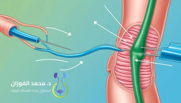 متى تحتاج دوالي الخصية إلى عملية؟