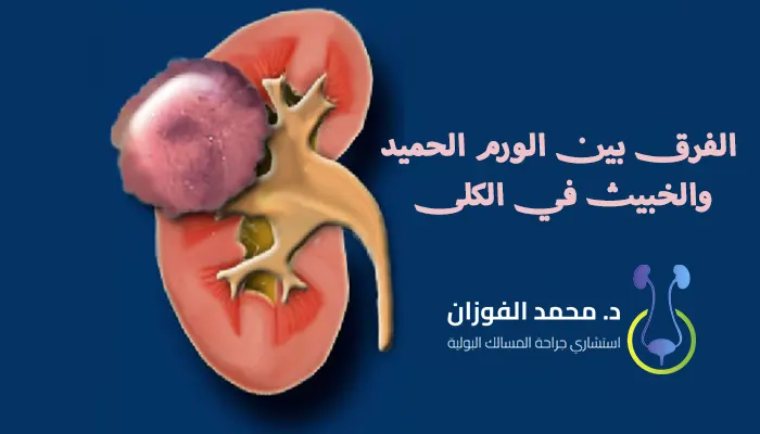 الفرق بين الورم الحميد والخبيث في الكلى