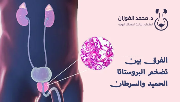 الفرق بين تضخم البروستاتا الحميد والسرطان