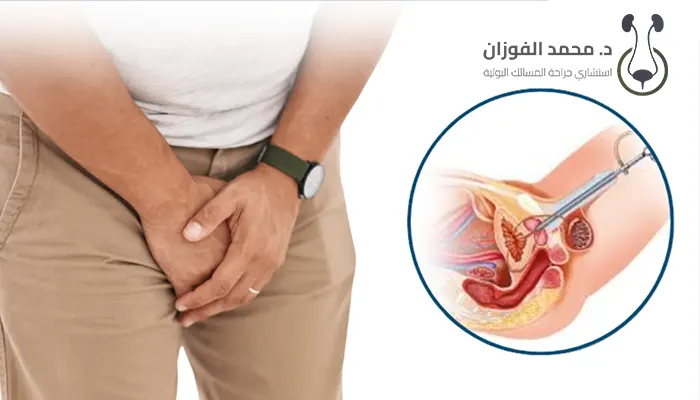 علاج تضيق الإحليل المتكرر