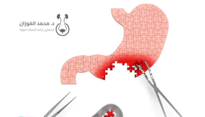 عملية استئصال ورم الكلى مع أفضل دكتور بالرياض