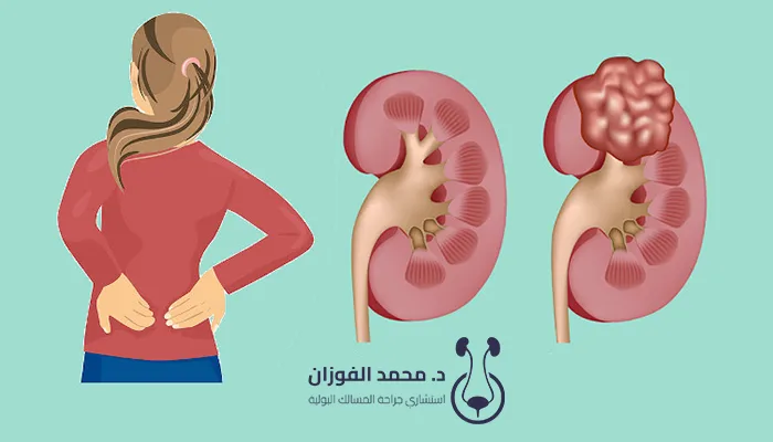 هل سرطان الكلى سريع الانتشار؟
