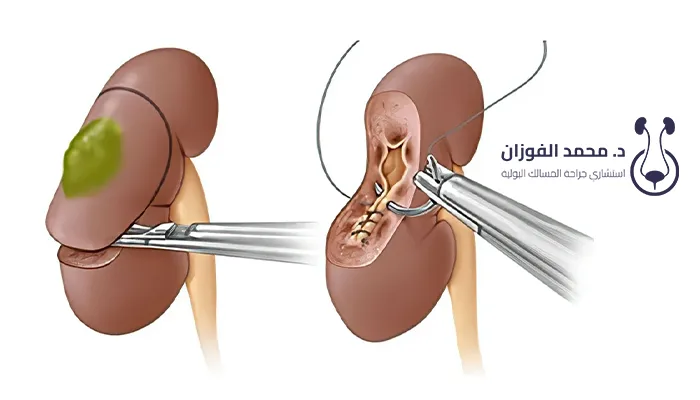 هل يعود سرطان الكلى بعد استئصاله؟