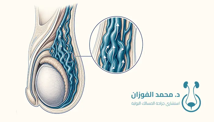 تأثير دوالي الخصية على هرمون الذكورة